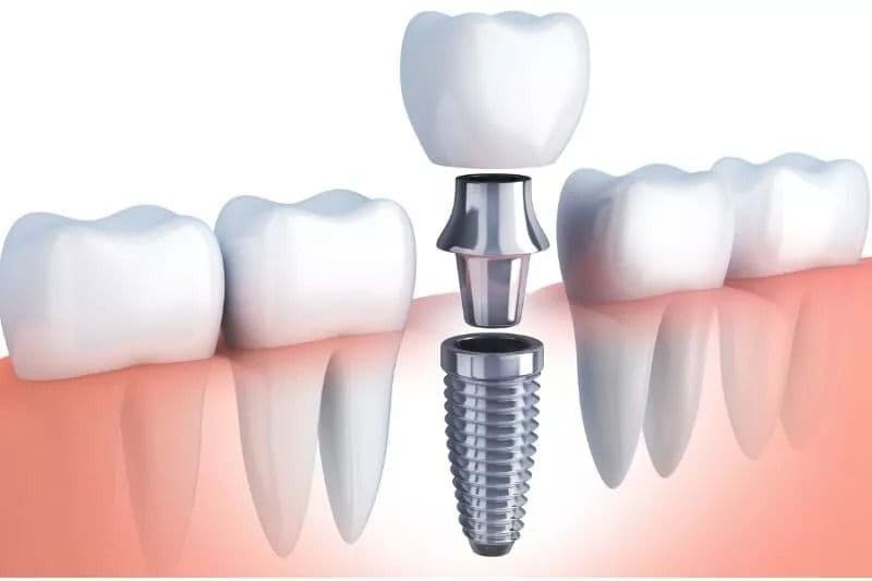 Why - Dental Implants in India: Benefit And Cost
