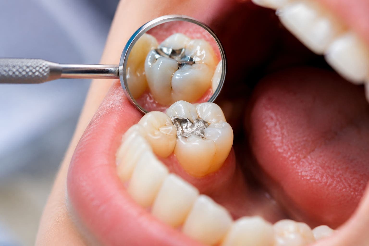 Dental Fillings